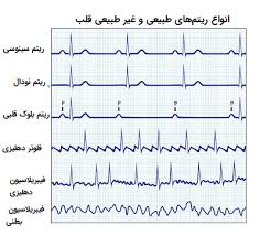 پاورپوینت تفسیر نوار قلب و اقدامات پرستاری