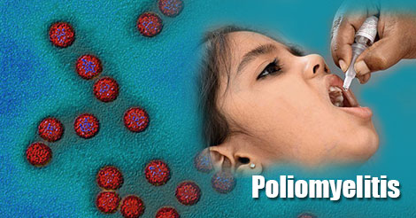 پاورپوینت  اپیدمیولوژی فلج کودکان  (Poliomyelitis)